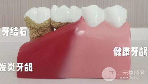 洗牙消毒降低风险吗