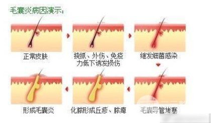 杭州市一医院植发案例