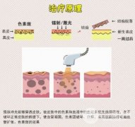 光子嫩肤和彩光嫩肤一样?No~区别太大了!