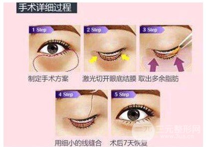 吸脂去下眼袋的方法具体是怎样的