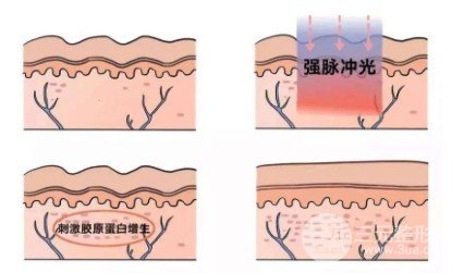 怎样去除痘疤