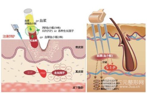怎样去除痘疤
