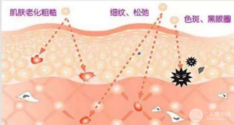 光子嫩肤缓解酒糟鼻