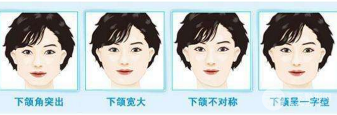 下颌角磨骨术恢复