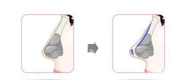 塌鼻子想要变美？教你一招怎样垫高鼻梁！