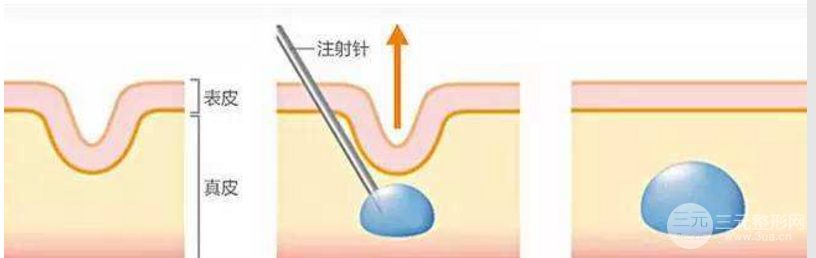 注射胶原蛋白