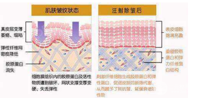 注射胶原蛋白