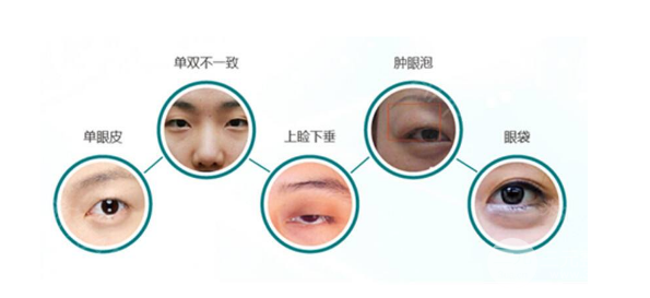 眼部整形术前注意事项