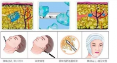 光纤溶脂瘦脸多久看到果？注意事项有哪些？