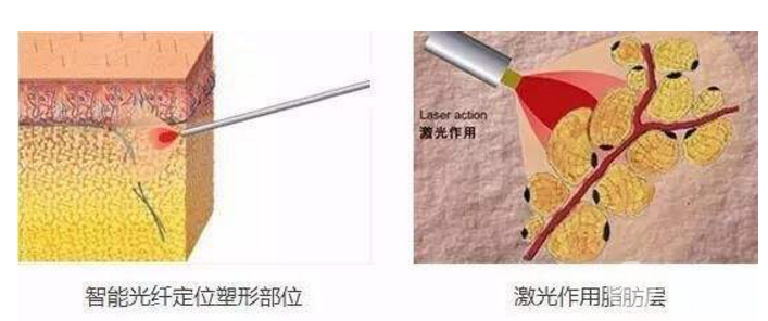光纤溶脂瘦脸