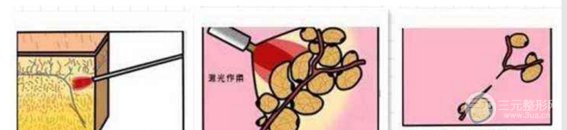 光纤溶脂瘦脸