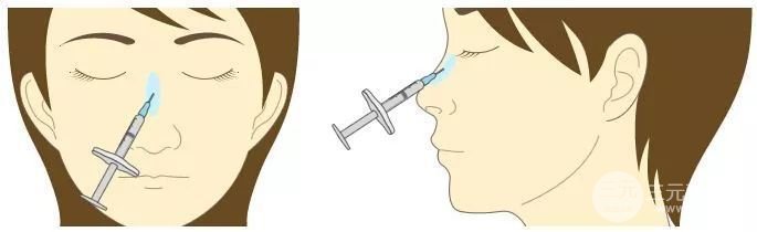注射隆鼻好还是假体好