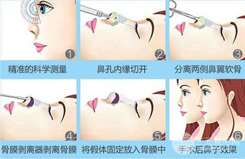 注射隆鼻好还是假体好