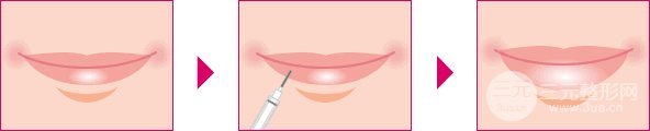玻尿酸丰唇手术和M唇手术如何选择