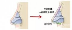 骨粉隆鼻后遗症有哪些？这么坑的隆鼻方法别再相信了！