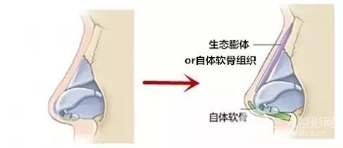 骨粉隆鼻后遗症