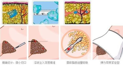 腰腹部吸脂价格