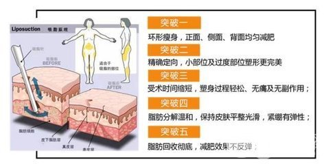 腰腹部吸脂价格