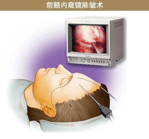 内窥镜除皱手术能保持多久