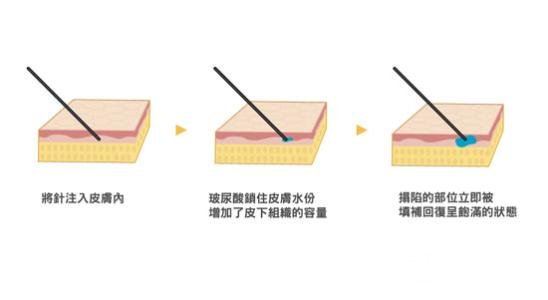 玻尿酸一支多少钱