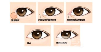 双眼皮可以开眼角吗