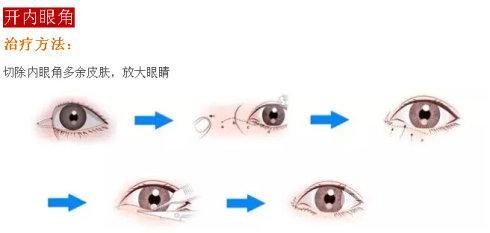 双眼皮可以开眼角吗