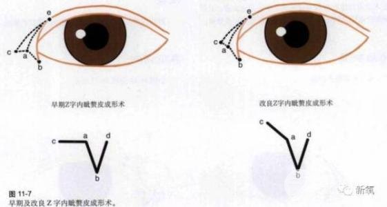 双眼皮可以开眼角吗