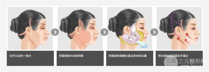面部除皱术价格