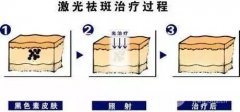 激光祛斑的价格贵吗？一般是多少钱？