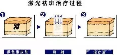 激光祛斑的价格