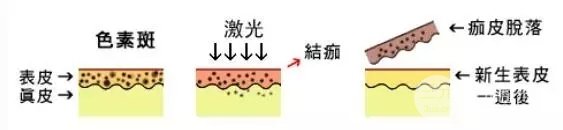 激光祛斑的价格