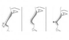 膨体隆鼻后取出会怎么样？看看“后悔药”怎么说