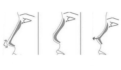 膨体隆鼻后取出