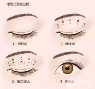[拒绝衰老]眼部提升手术讲解，掩藏你的年龄秘密！