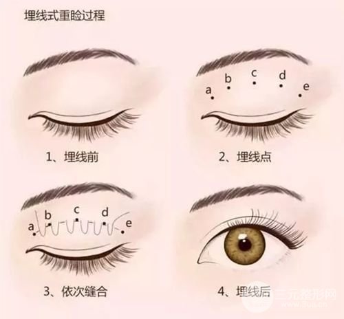 [拒绝衰老]眼部提升手术