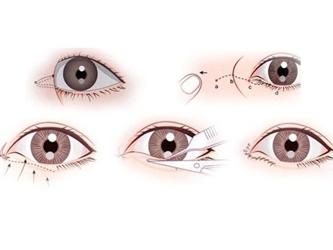 [拒绝衰老]眼部提升手术