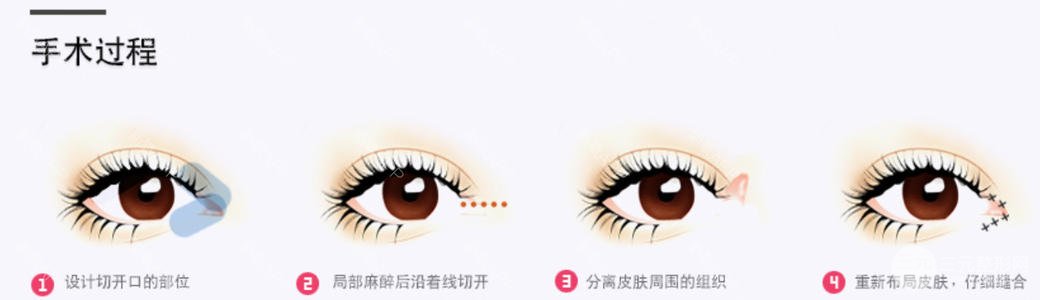 [拒绝衰老]眼部提升手术