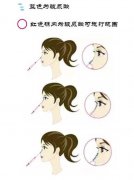 玻尿酸隆鼻价格贵吗？能维持多久？