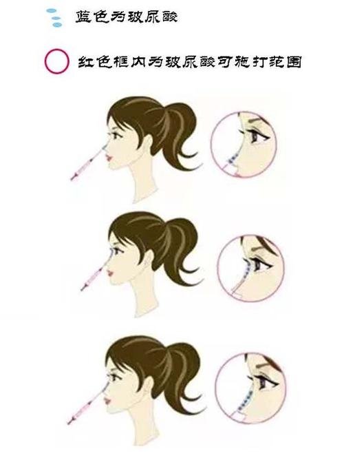 玻尿酸隆鼻