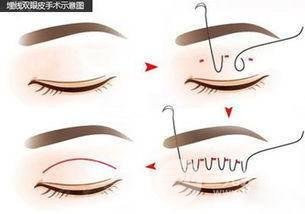 [拒绝衰老]眼部提升手术