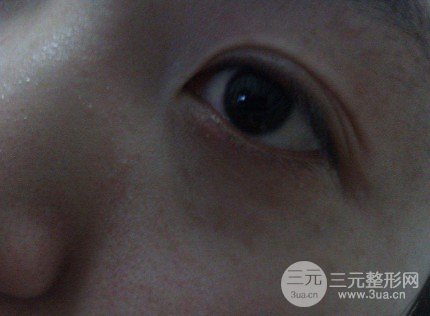 眼袋和黑眼圈的区别