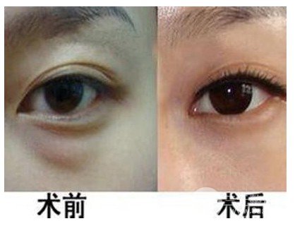 眼袋和黑眼圈的区别