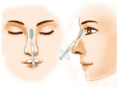 玻尿酸注射隆鼻手术间隔多久