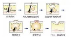 痤疮一直反复治累了，痤疮激光缓解多少钱?