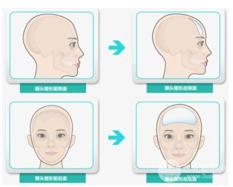 自体脂肪额头填充的果图