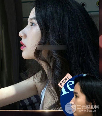 硅胶隆鼻整形术假体