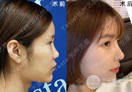 硅胶隆鼻整形术假体