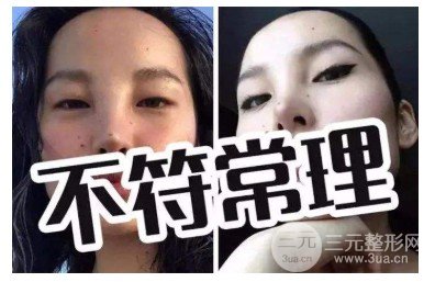 玻尿酸隆鼻山根变宽的原因