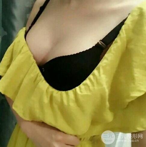 广州隆胸手术案例反馈
