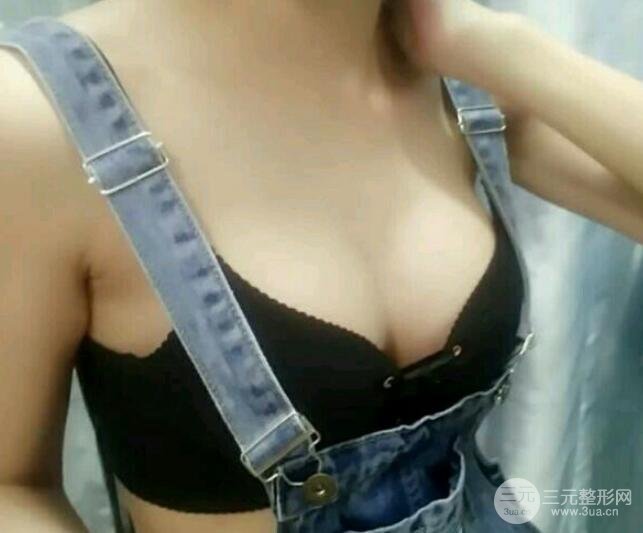 广州隆胸手术案例反馈